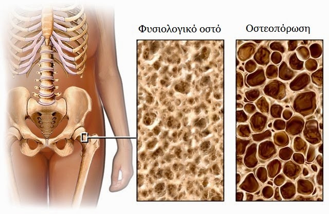 osteoporosis11
